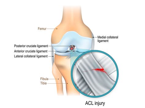 ACL surgery cost