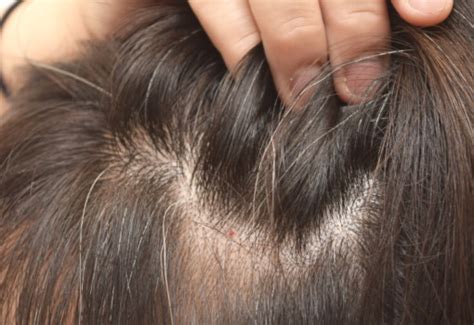 Hair Thinning and Demodex Mites | Ungex | Demodex Treatment