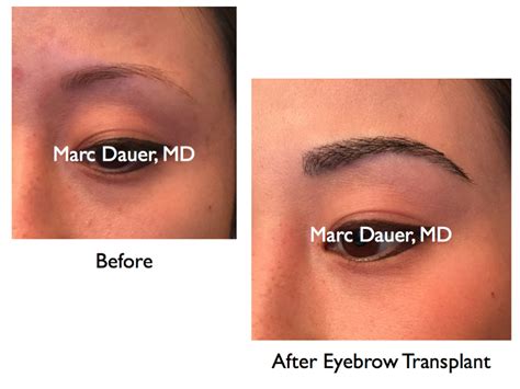 Eyebrow Restoration Los Angeles, Eyebrow Transplant Procedure