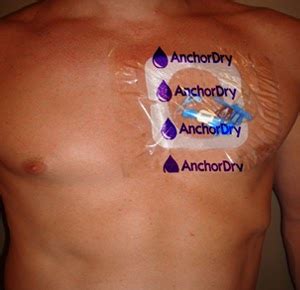 Kidney Dialysis Port In Chest