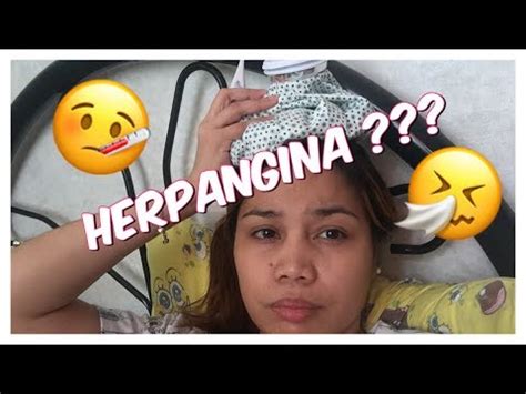 HERPANGINA?? SYMPTOMS AND TREATMENT - YouTube