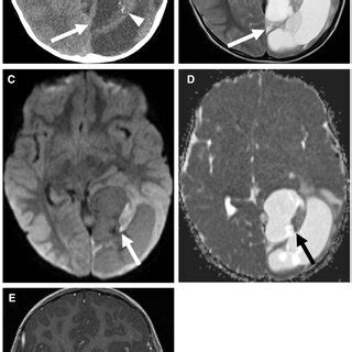 Supratentorial ependymoma, YAP1 fusion-positive. Multiple MRI sequences... | Download Scientific ...