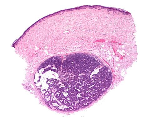 Eccrine spiradenoma - Libre Pathology