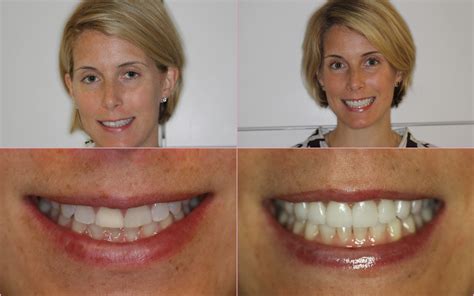 Porcelain Veneers Chicago ~ Before and After ~ July Case of the Month ...