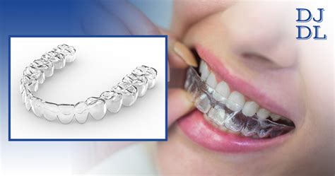 Essix Retainers: A must have asset after braces. | Blog