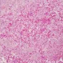 PAS stain of valvular tissue (x400 magnification) demonstrating... | Download Scientific Diagram