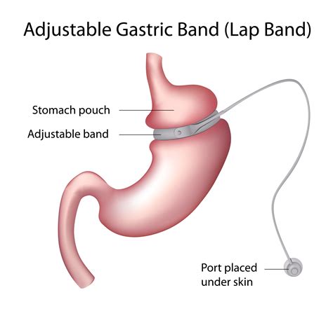 Laparoscopic Adjustable Gastric Banding | Dr. Edward Oliveros