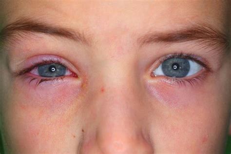 13 Symptoms Of Pink Eye (Conjunctivitis) In Kids & Treatment