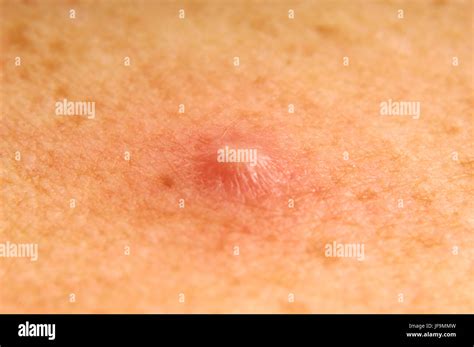 Pus wound hi-res stock photography and images - Alamy