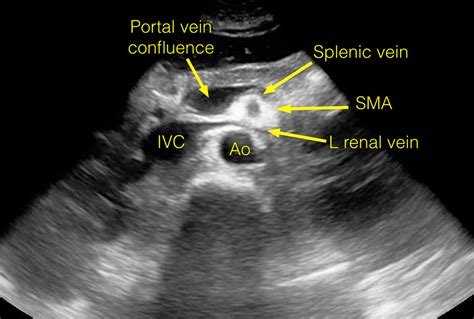 Emergency Ultrasound Cases | NYU Langone Health