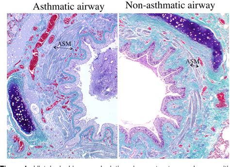 Asthma Histology