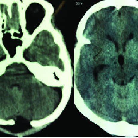 T1 and T2 MRI showing descended cerebellar tonsils and wide syrinx... | Download Scientific Diagram