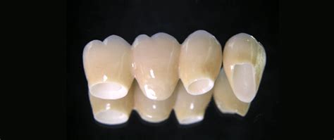 CAD CAM Crowns - Avant Dental