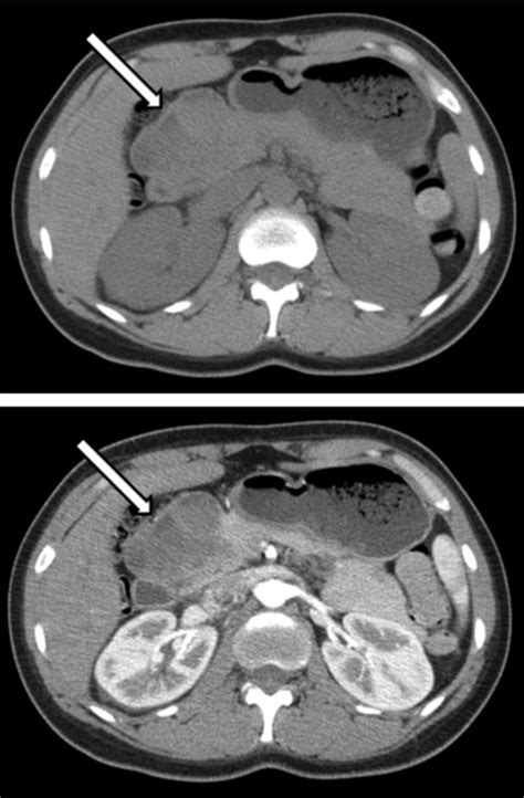 Non-contrast and post-contrast axial CT images demonstrate an ...