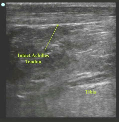 Achilles Tendon Rupture | Emory School of Medicine