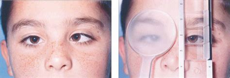 Strabismus | Clinical Gate