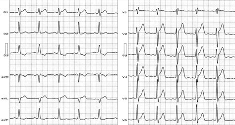 ECG of a young male athlete with normal heart. Clinical diagnosis:... | Download Scientific Diagram