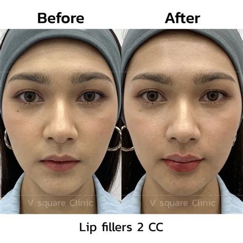 Lip filler injection add sexy fullness, where to go, reviews and prices