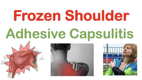 Frozen Shoulder (Adhesive Capsulitis): Causes, Symptoms, Stages, Diagnosis, Treatment - YouTube