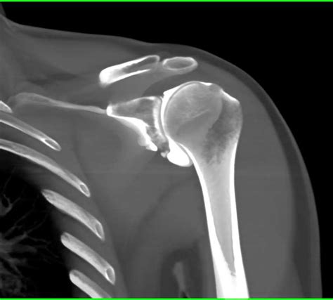 CT Shoulder Arthrogram in 3D - Musculoskeletal Case Studies - CTisus CT Scanning