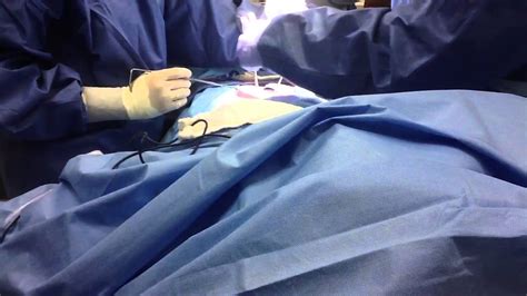 Part 1 of Bowel Resection Surgical Technology - YouTube