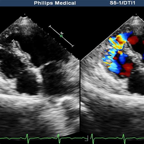 The patient’s cardiac ultrasound results after admission (apical ...