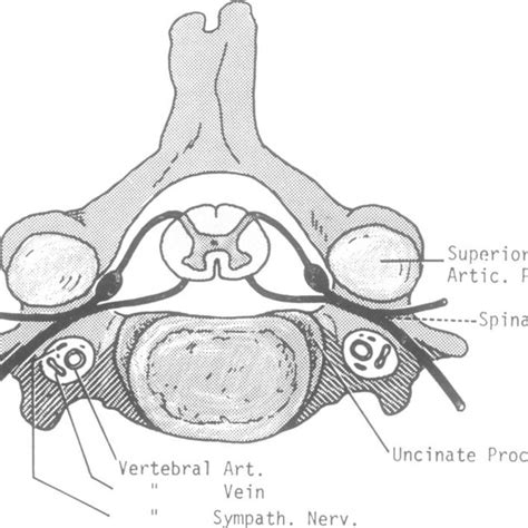 C3 vertebra; superior view. The surface of the left articular process... | Download Scientific ...