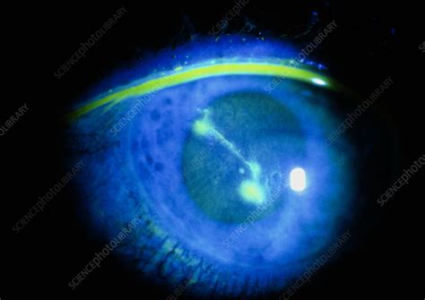 Corneal abrasion - Stock Image - M155/0219 - Science Photo Library