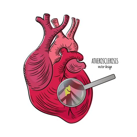 Premium Vector | Heart disease atherosclerosis medicine education