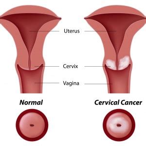 Natural Treatment for HPV, Cervical Dysplasia, Abnormal PAP