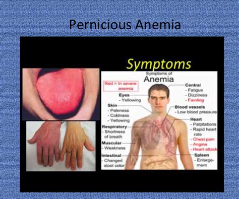 How To Diagnose Pernicious Anemia - Riseband2