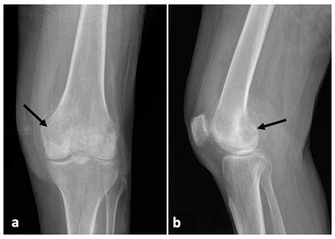 Applied Sciences | Free Full-Text | Malignant Knee Joint Effusion—A New Dimension of Laboratory ...