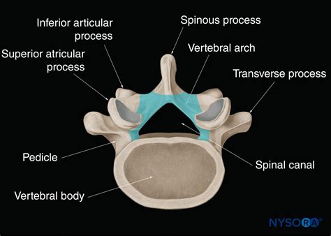 Unsegmented Bar Vertebrae