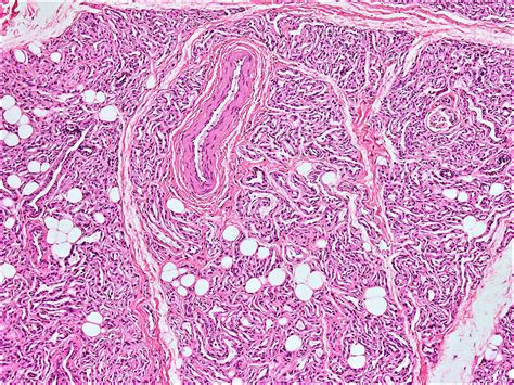 Skin Hemangioma Histology