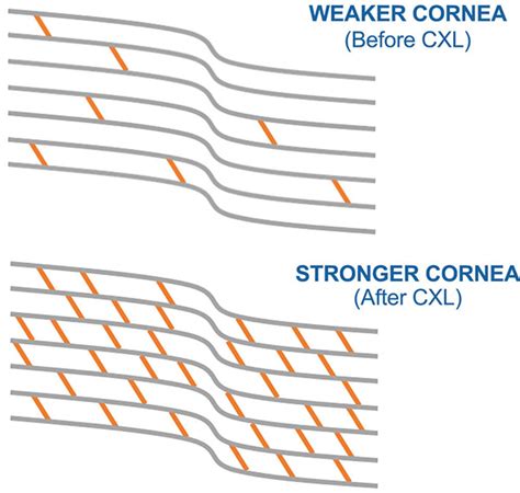 Corneal Cross-Linking Stillwater | CXL St Paul | Associated Eye Care