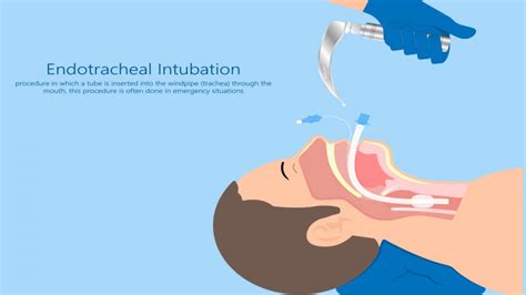 Comment éviter les complications de l’intubation en réanimation ? | SRLF