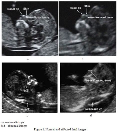 A Review on Techniques for Computer Aided Diagnosis of Soft Markers for Detection of Down ...