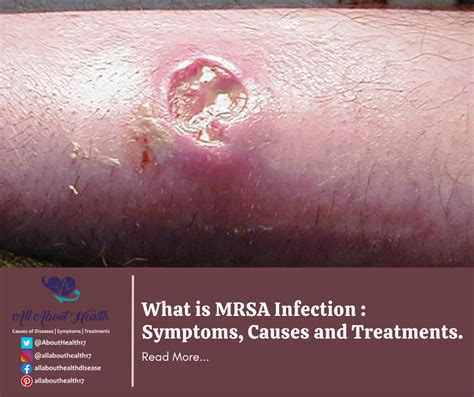 What is MRSA Infection : Symptoms, Causes and Treatments. - All About ...