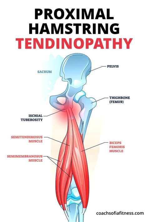 Hamstring Tendonitis: Rehab Exercises for Relief - Coach Sofia Fitness