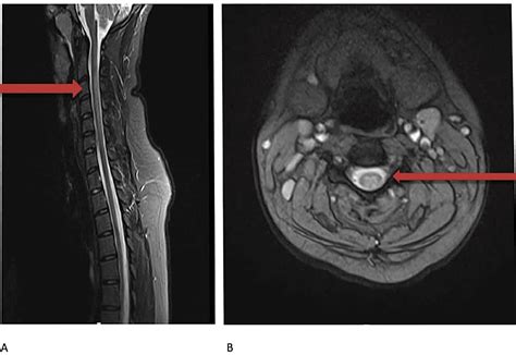 Subacute Combined Degeneration of the Spinal Cord Secondary to Nitrous ...