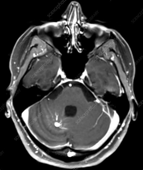 Large Developmental Venous Anomaly, MRI - Stock Image - C030/6372 ...