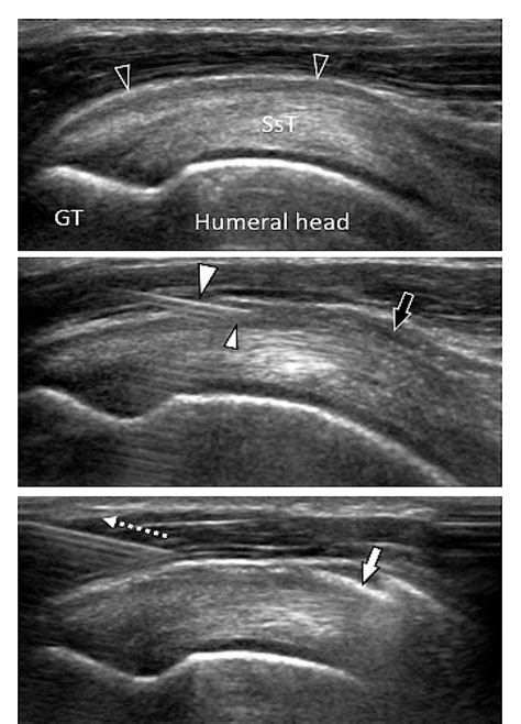 US guided corticosteroid injection into the subacromial-subdeltoid bursa: Technique and approach ...