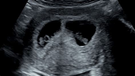 How Early Can I See Twins on a Scan? - firstScan at Window to the Womb