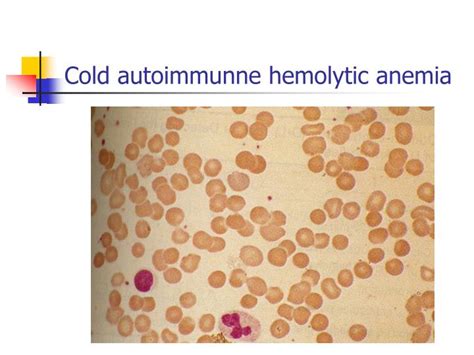 PPT - Hemolytic Anemias - Extracorpuscular defects PowerPoint Presentation - ID:1827466