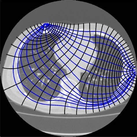 Electrical impedance tomography - Alchetron, the free social encyclopedia