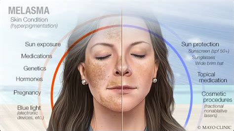 Mayo Clinic Q and A: Treating melasma - Mayo Clinic News Network