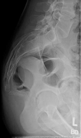 Coccyx X Ray Positioning