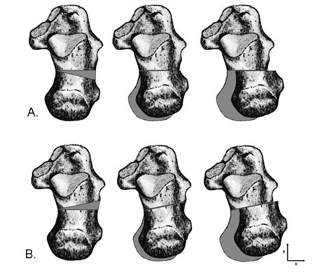 Calcaneal Osteotomies Tips and Tricks — Doctor Andrés León - Consulta ...