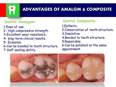 Amalgam &composite