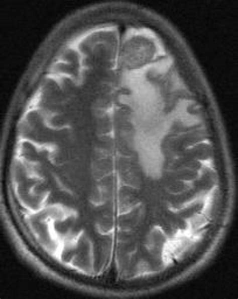 Brain tumor differential diagnosis - wikidoc